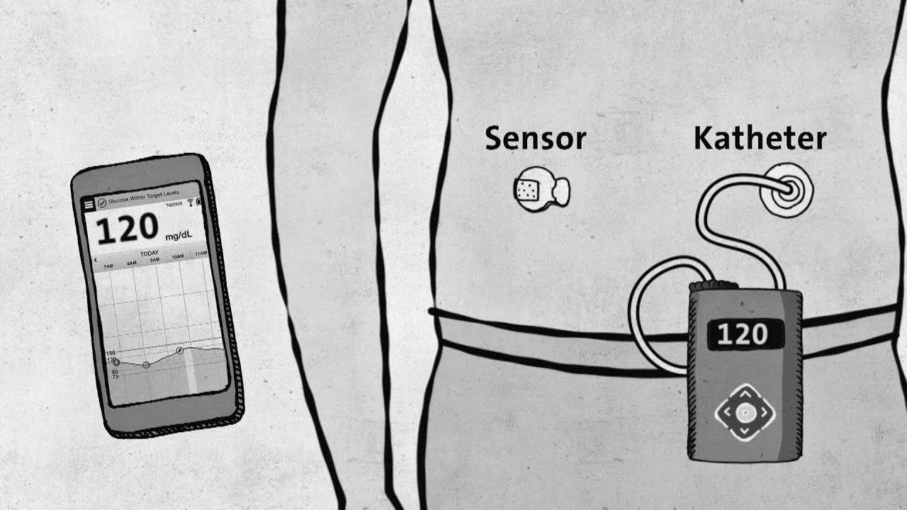 Type 1 diabetes – modern technology with out approval – good to know